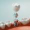 Dental-Implants