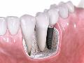 The Social Impact of Dental Implants - Smiling with Confidence