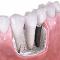 Dental-Implants