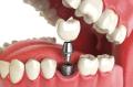 Eating Your Favourite Foods Again - How Dental Implants Restore Your Diet