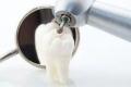 The Role of Quality in Dental Implant Costs  Why Cutting Corners Isn't Worth It