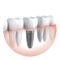 Recovery After a Sports Injury - How Dental Implants Can Help