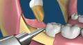 Top Health Reasons to Remove Your Wisdom Teeth