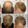 Scalp-MicroPigmentation-before-and-after-adelaide-