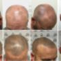 Scalp-micropigmentation-before-and-after-adelaide