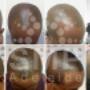 scalp-micropigmentation-adelaide-before-and-after-