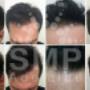 scalp-micropigmentation-adelaide-before-and-after-