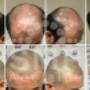 scalp-micropigmentation-adelaide-before-and-after-