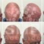 scalp-micropigmentation-adelaide-before-and-after-