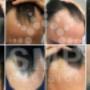 scalp-micropigmentation-adelaide-before-and-after-