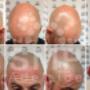 scalp-micropigmentation-adelaide-before-and-after-