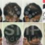 scalp-micropigmentation-adelaide-before-and-after-