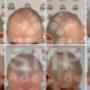 scalp-micropigmentation-adelaide-before-and-after1