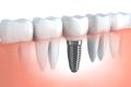 Factors Affecting the Cost of Dental Implant