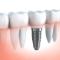 Cost-of-Dental-Implant