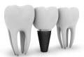 Understanding Dental Implants Cost  What to Expect