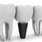 Dental-Implants-Cost