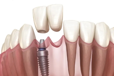 Dental-Implants