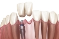 Getting Your Smile Back on Track A Guide to Dental Implants in Melbourne