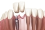 Dental-Implants