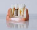 How to Get Quality Dental Implants without Breaking the Bank