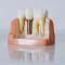 Quality-Dental-Implants