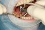 dental implants Melbourne cost