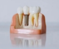 Dental Implants – Be in the Know with these Tips