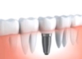 Popular Kinds of Dental Implants
