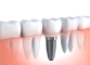 Popular Kinds of Dental Implants