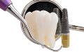 Risks of Getting Dental Implant Overseas