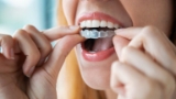 Invisalign - westpoint dental clinic - blacktown