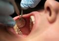 The Risks and Consequences of Ignoring Gum Disease