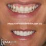 composite veneer