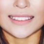 dental veneers