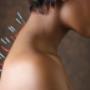 Acupuncture