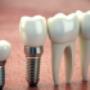 Debunking Myths and Unveiling Facts about Dental Implants