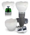 5 Facts That You Would Want To Know About Dental Implants