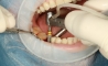 dental implants melbourne