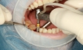 Everything You Need to Know About Dental Implants From Consultation to Recovery
