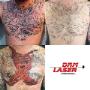 DRM Laser Tattoo Removal