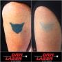 Laser Tattoo Removal