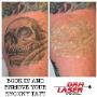 Tattoo Fading