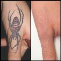 Painless Laser Tattoo Removal in Melbourne | Price Starts at $60 | DRM Laser