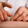 Acupuncture