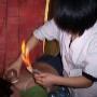 Cupping