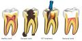 Root Canal Treatment Dentist