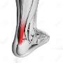 Achilles Pain