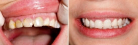 Dental Veneers