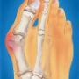 Bunions